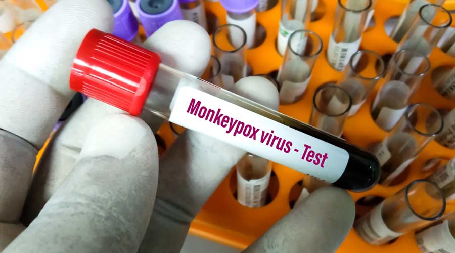 Blood sample tube for Monkeypox virus test. It is also known as the Moneypox virus, is a double-stranded DNA, zoonotic virus and a species of the genus Orthopoxvirus in the family Poxviridae
