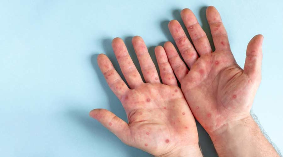 Monkeypox: What Is It, Causes, and More