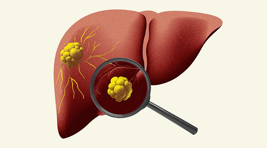 Stylized liver illustration with magnifying glass emphasizing diagnosis, organ health, and medical attention for treatment. Concept of health insurance, pharmacy,